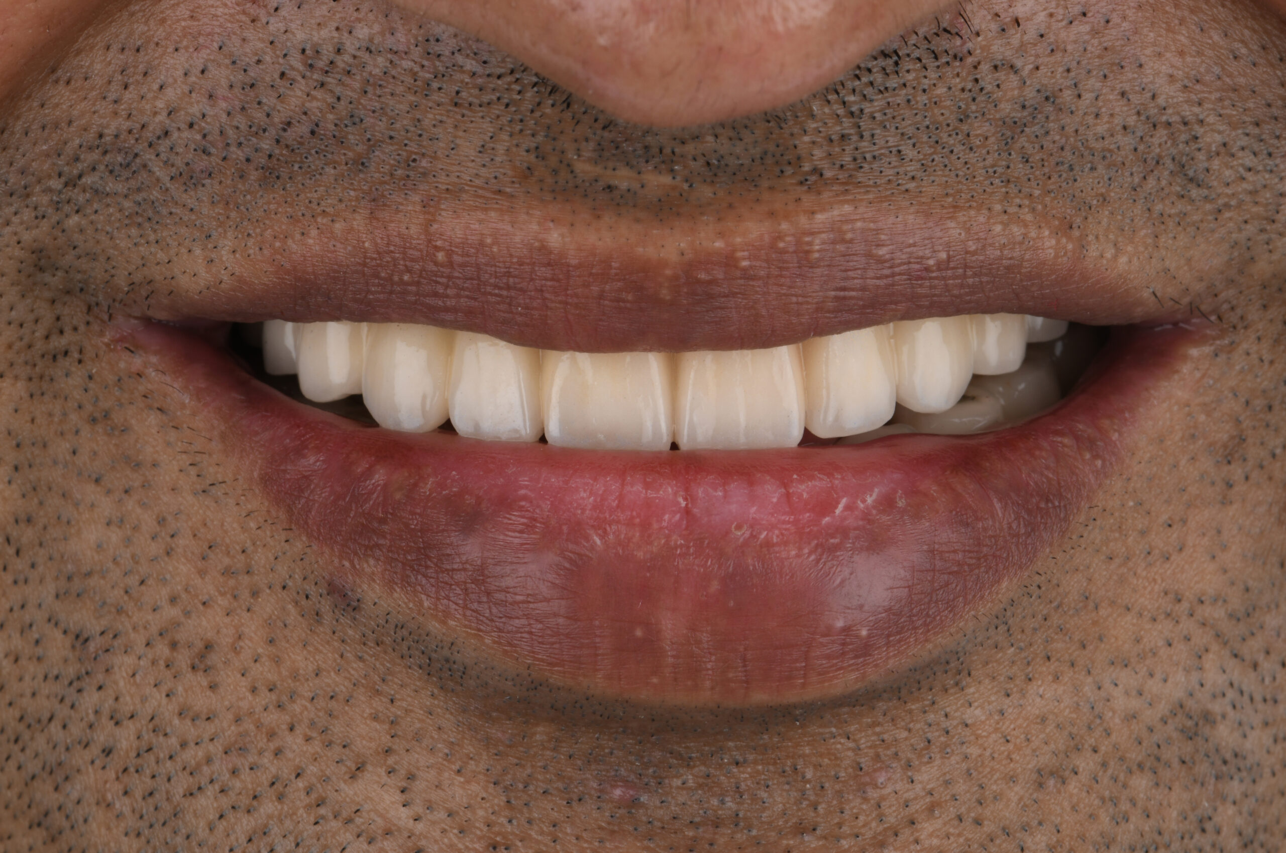 Full Mouth Rehabilitation in Chennai