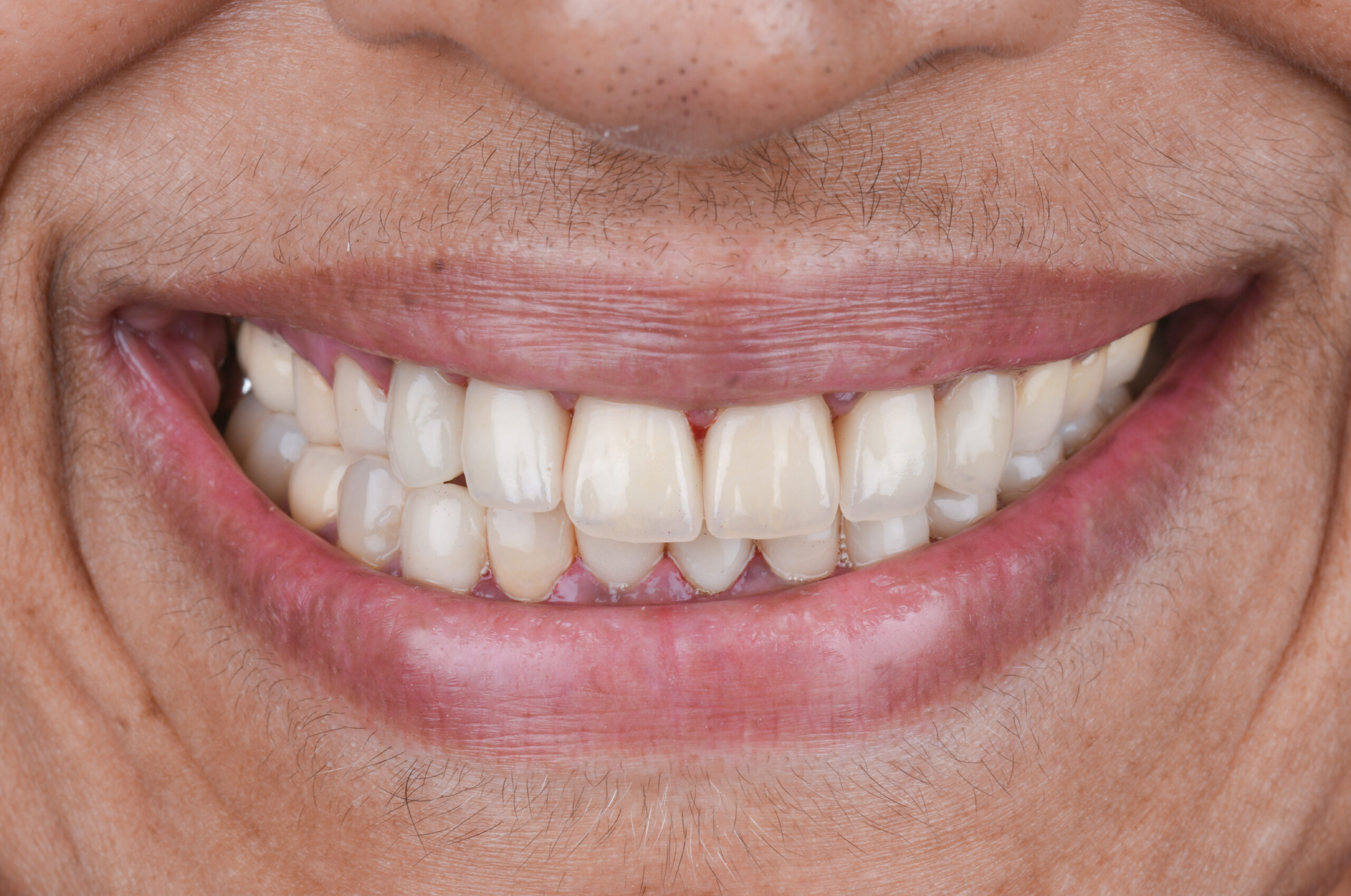 After smile makeover treatment