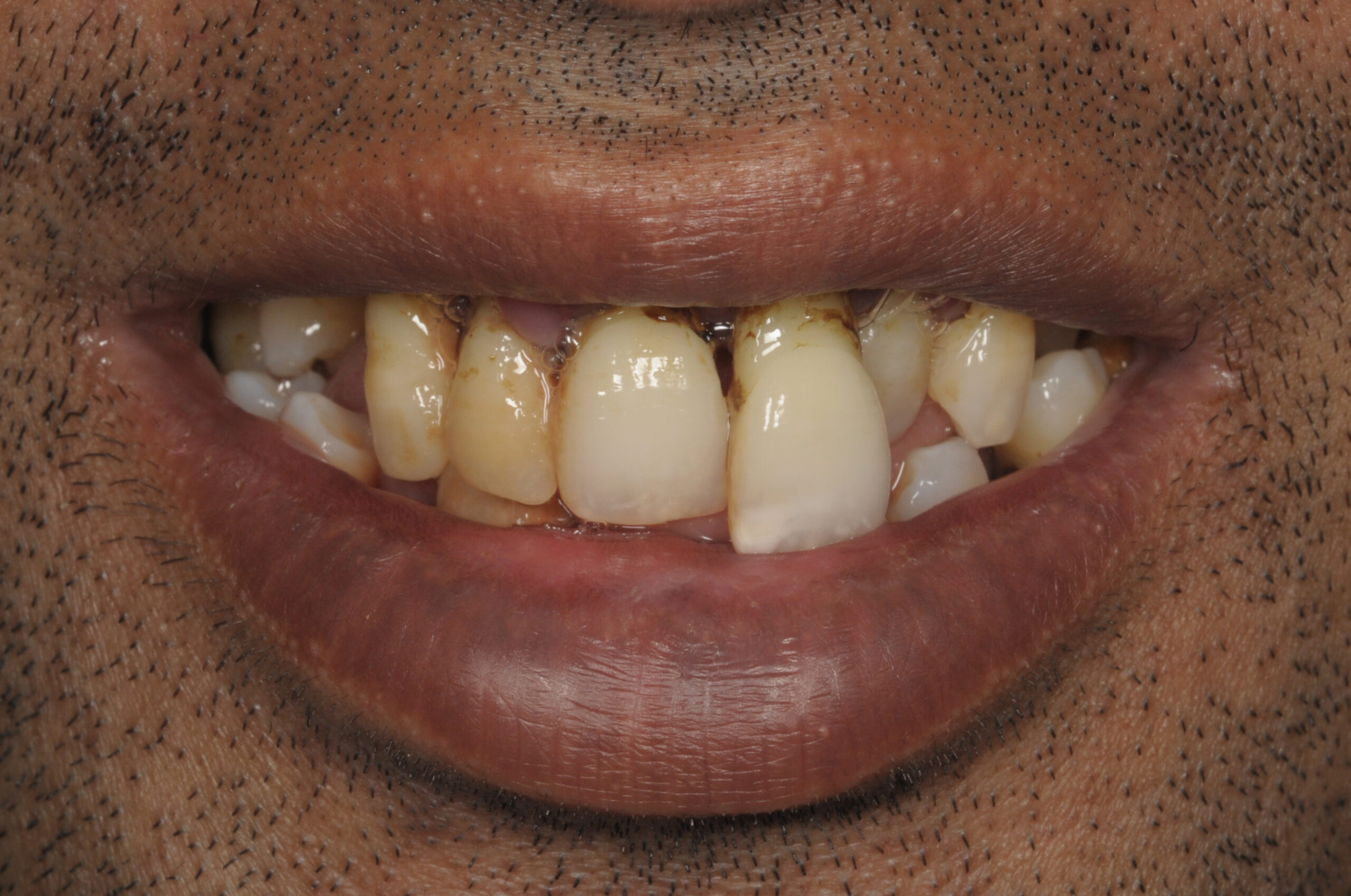 Full Mouth Rehabilitation in Chennai