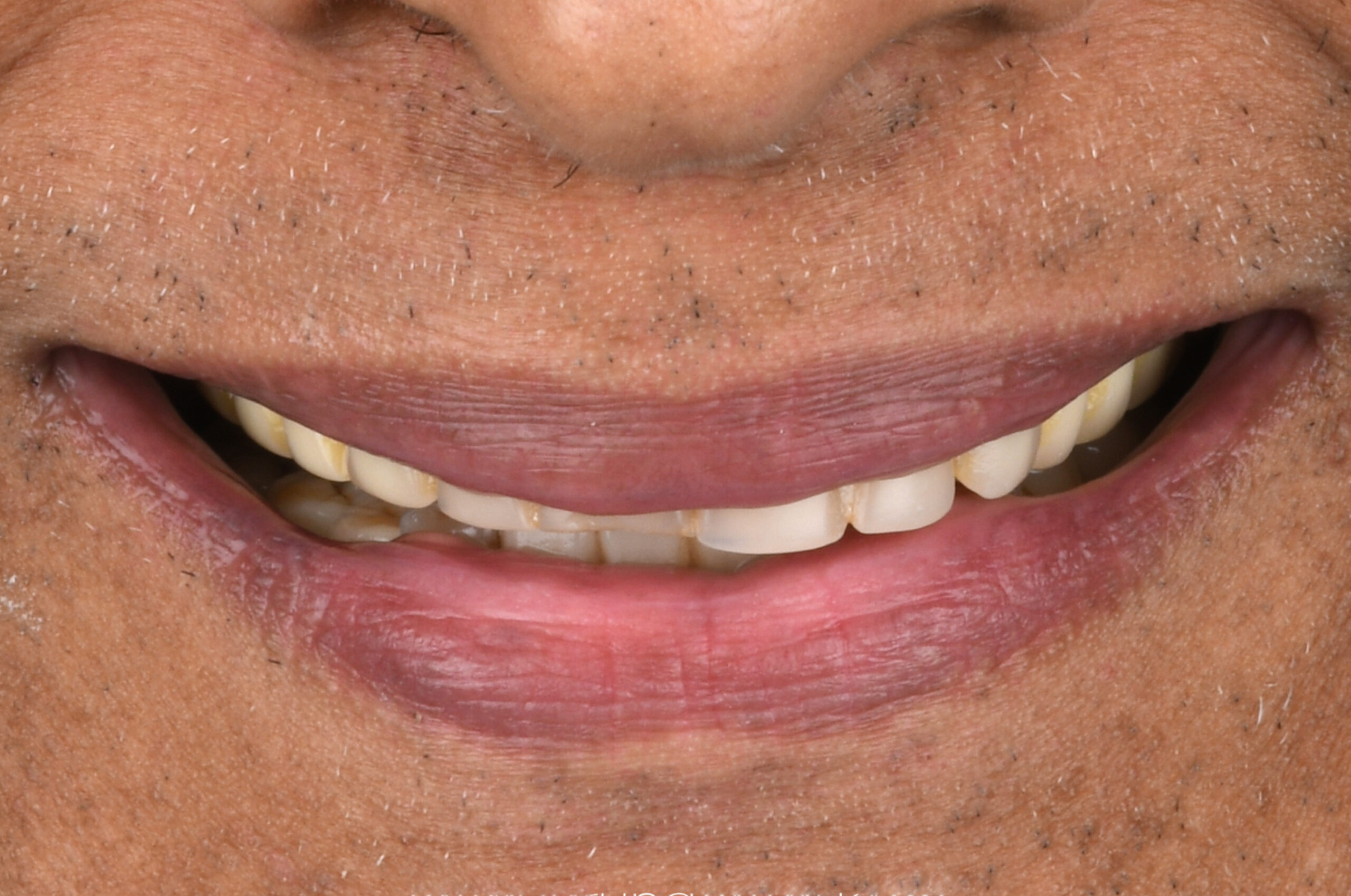Before dentures