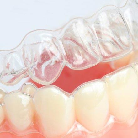 Invisalign