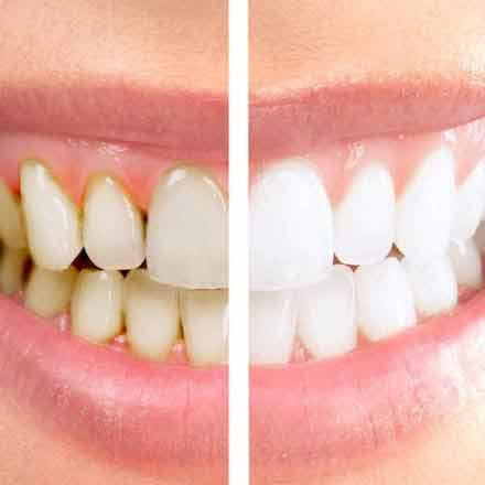 Teeth Whitening