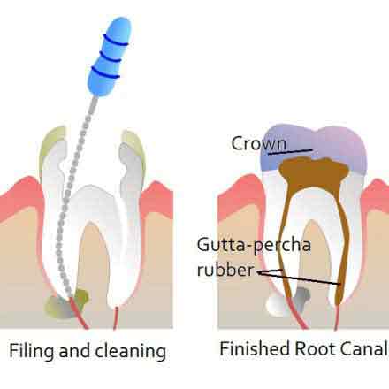 Root Canal Therapy